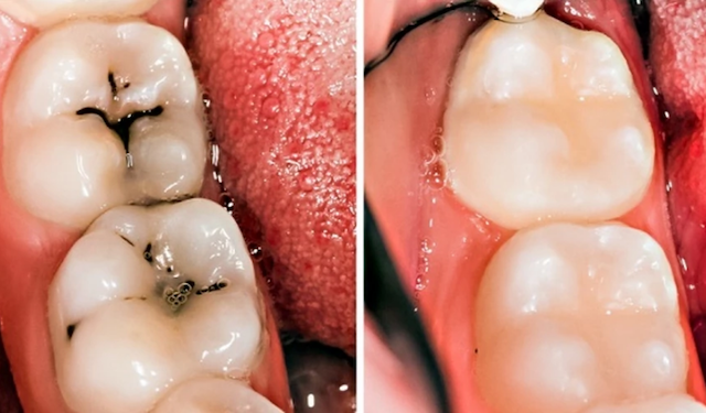 3 Home Remedies for Tooth Decay and Cavities That Work