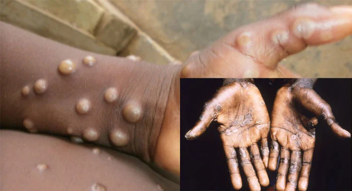 UKHSA confirms local spread of monkeypox